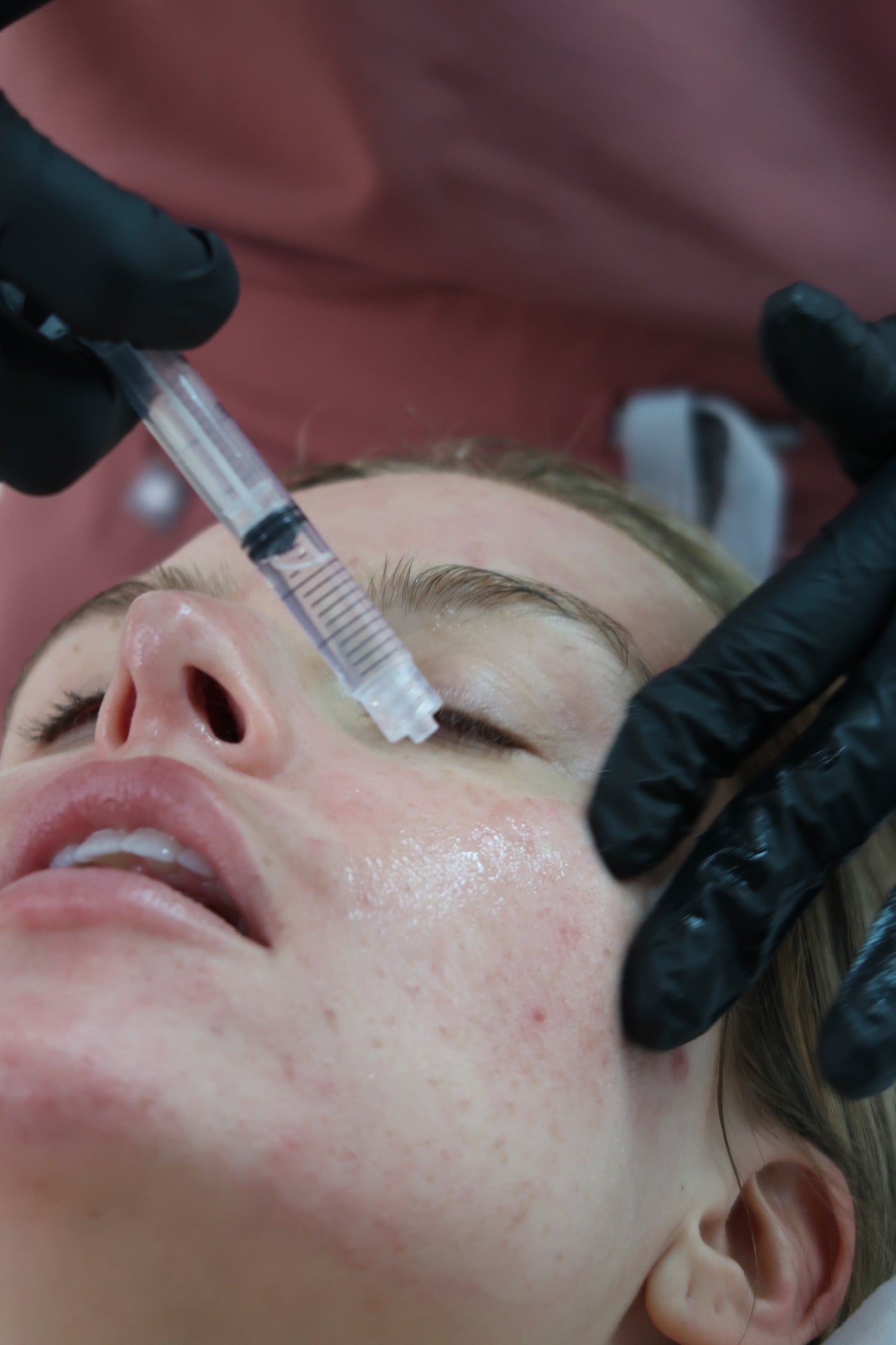 Microneedling with PRF or PDGF: Benefits, Differences, and Which Is Right for You