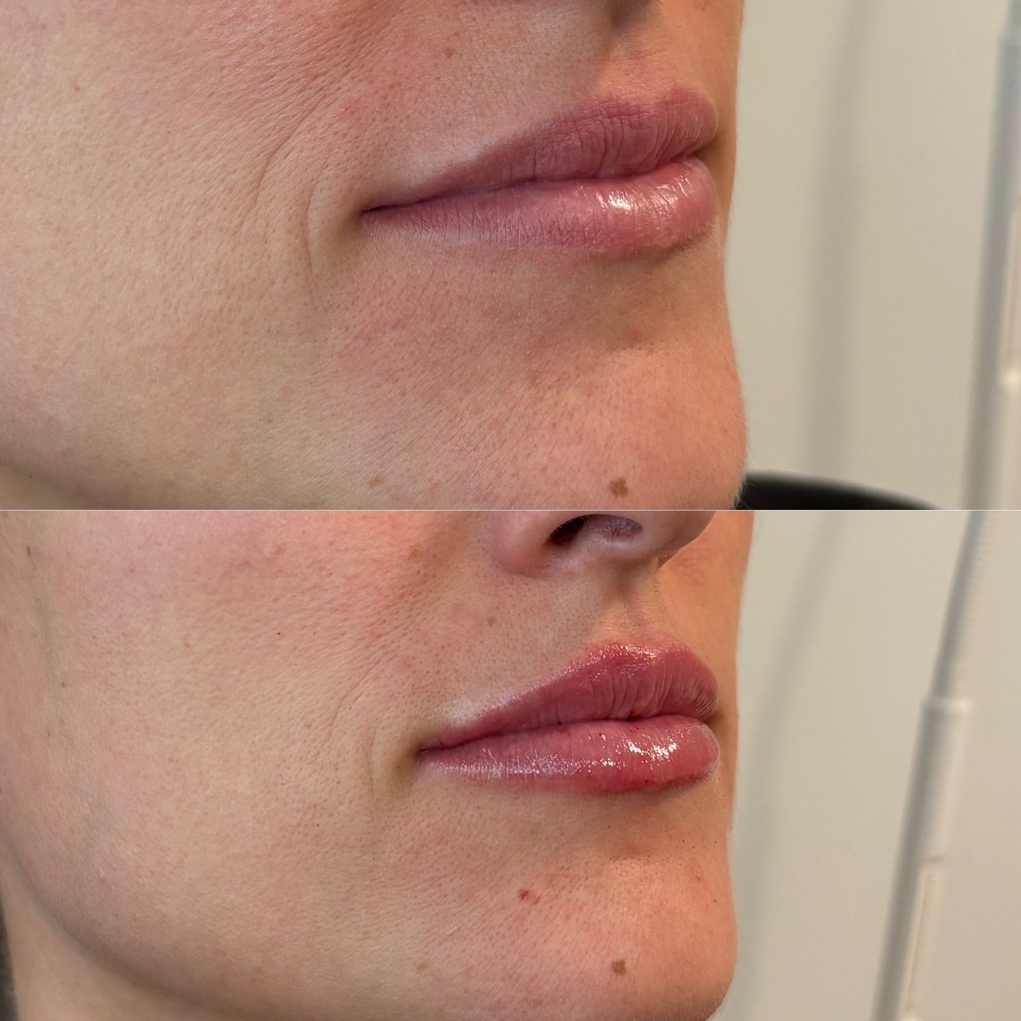 First-Time Lip Filler: What to Expect Before, During, and After Treatment