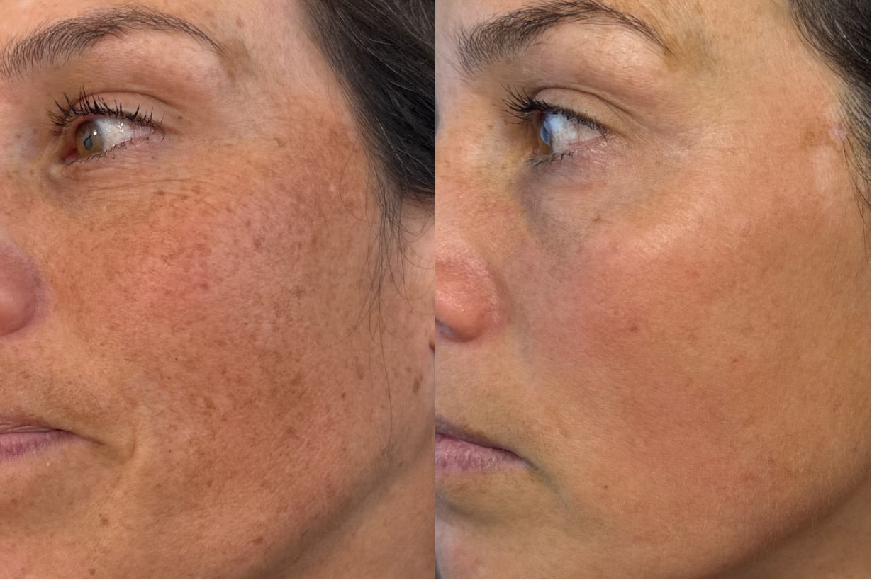 MOXI vs BBL: Which Treatment Is Right for You?