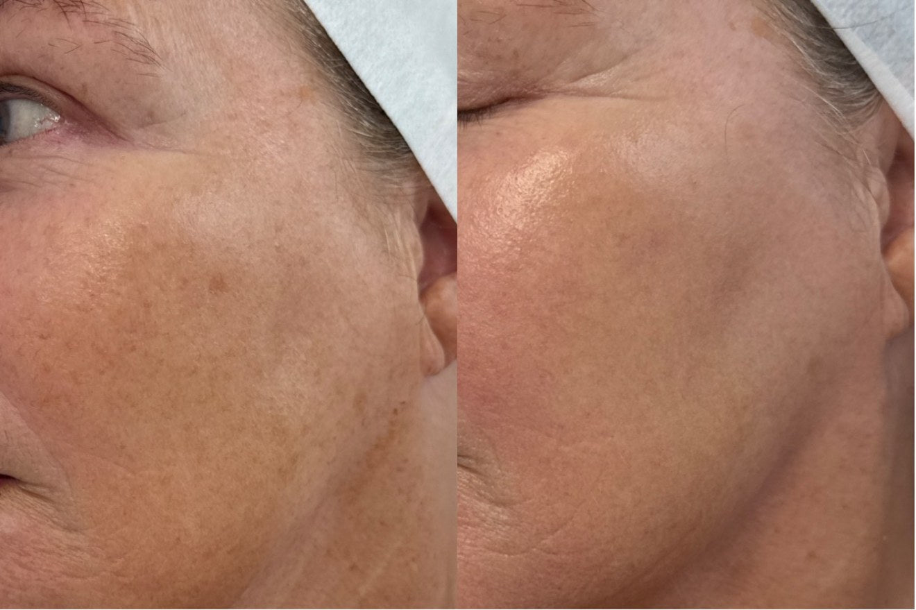 BBL + Moxi before and after — tone and texture, side profile