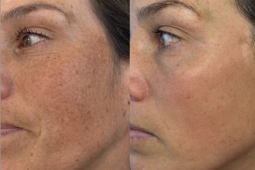 Laser Facial (BBL) before and after — pigmentation and sun damage, cheek profile