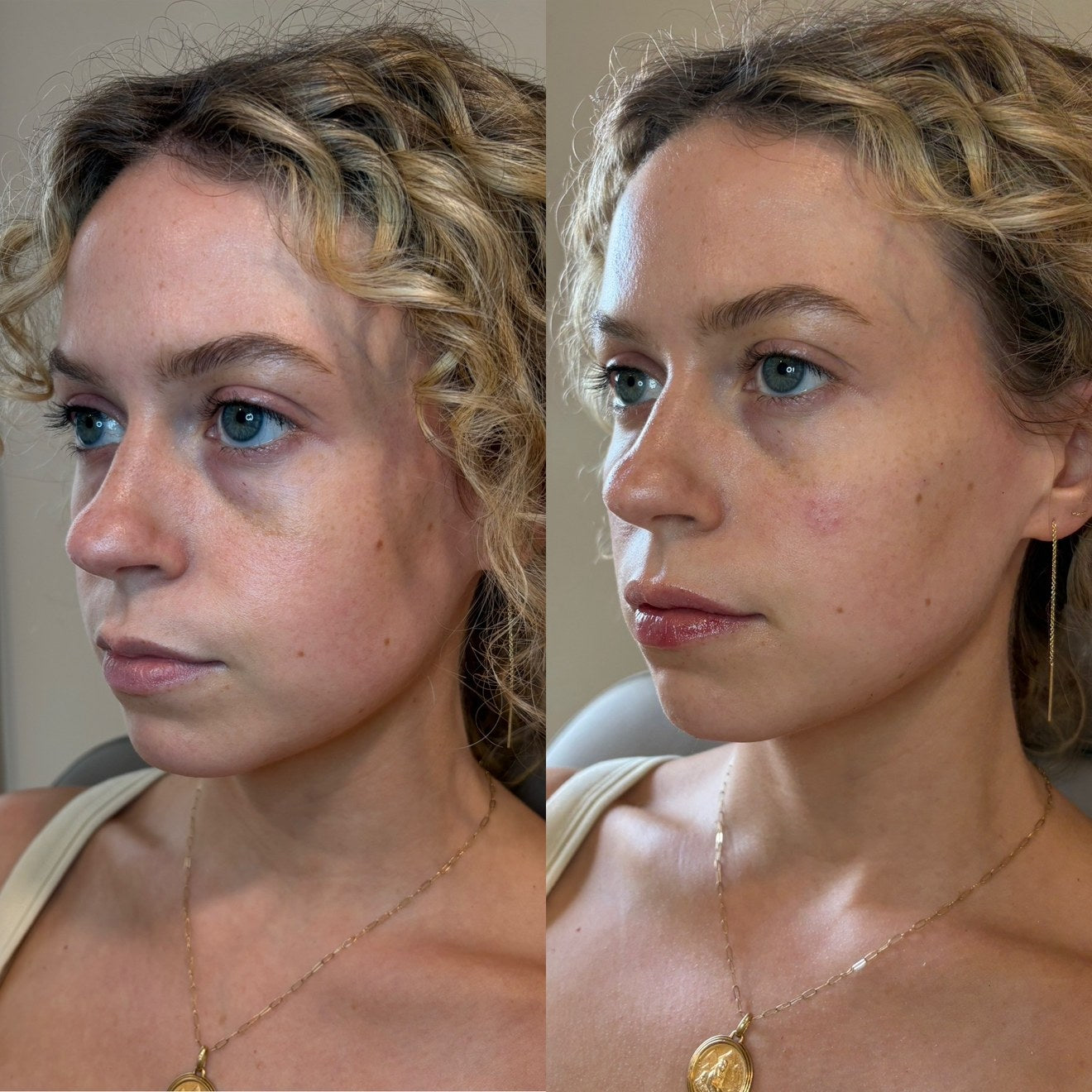 Facial filler before and after — facial balancing, three-quarter profile
