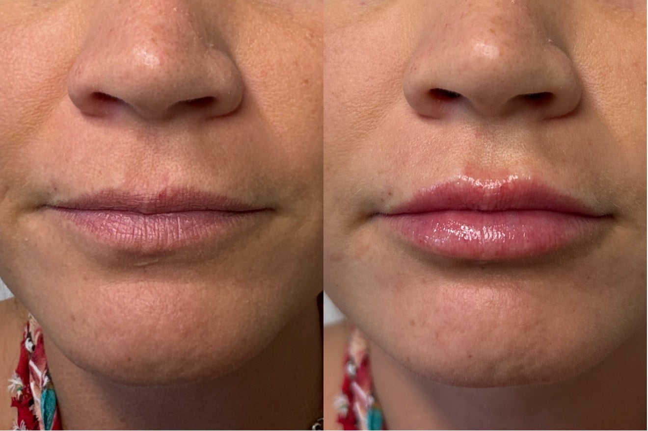 Lip filler before and after — lip shape and volume, close-up