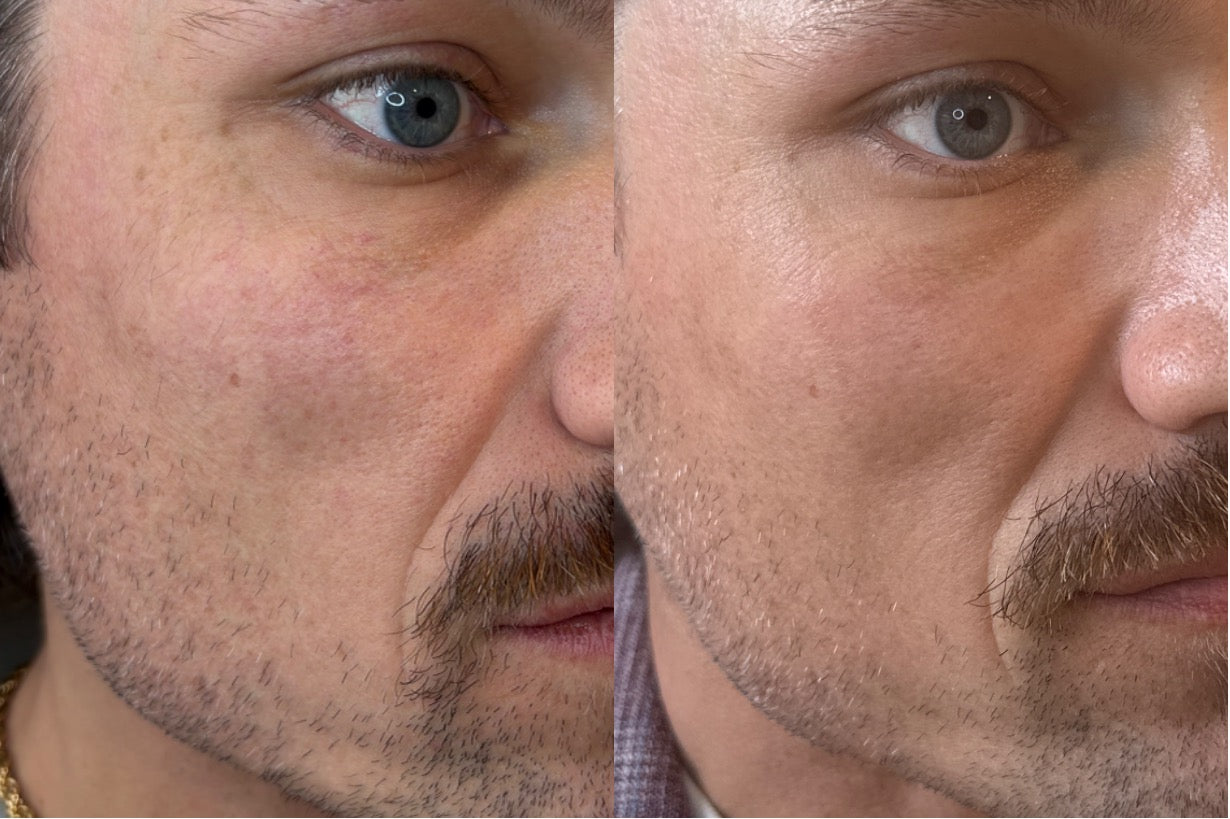 Microneedling before and after — skin texture, male client cheek detail