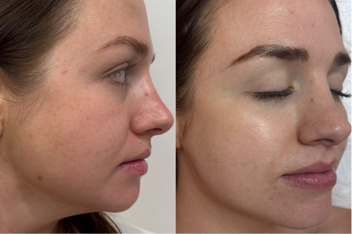 Microneedling before and after — skin clarity and texture, side profile