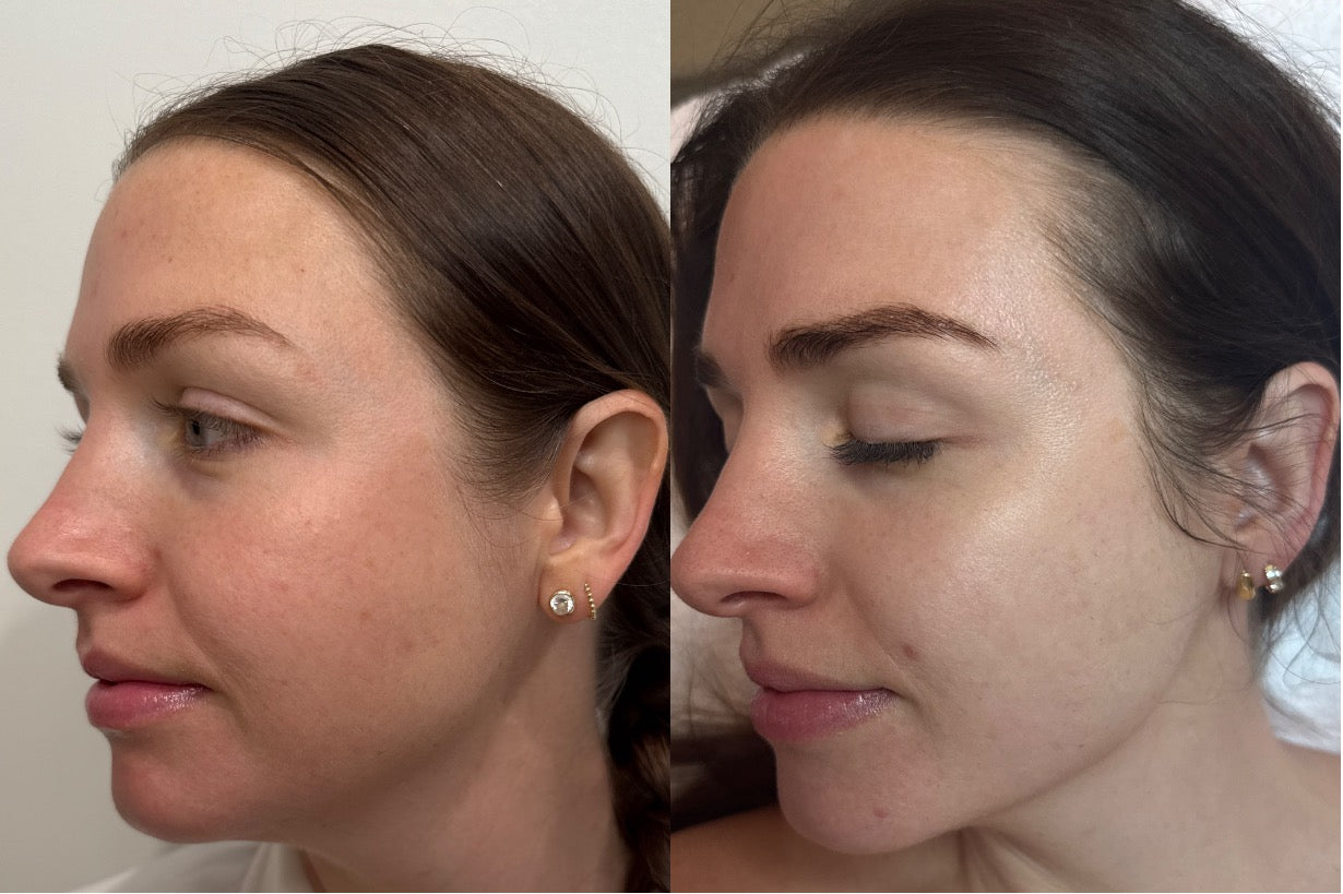 Microneedling before and after — skin tone and texture, side profile