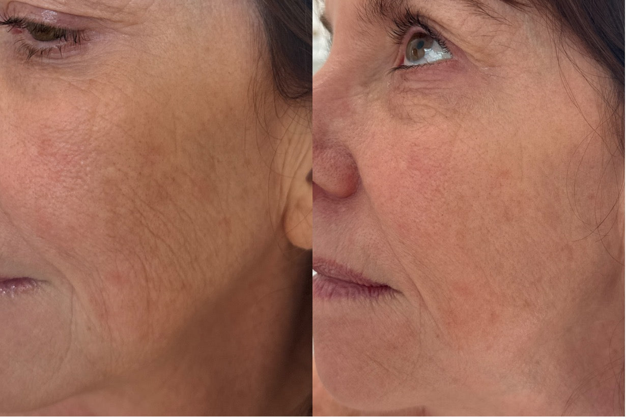Moxi before and after — skin texture and fine lines, cheek detail
