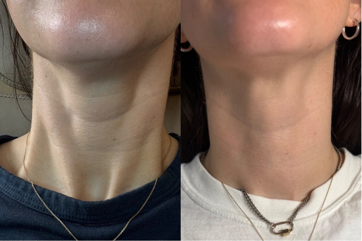 PRF before and after — neck skin quality