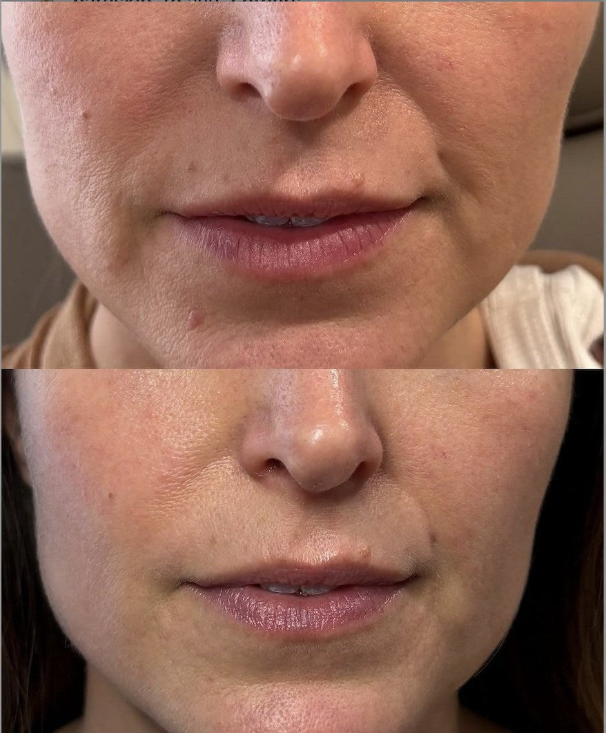 PRF before and after — perioral lines around the mouth
