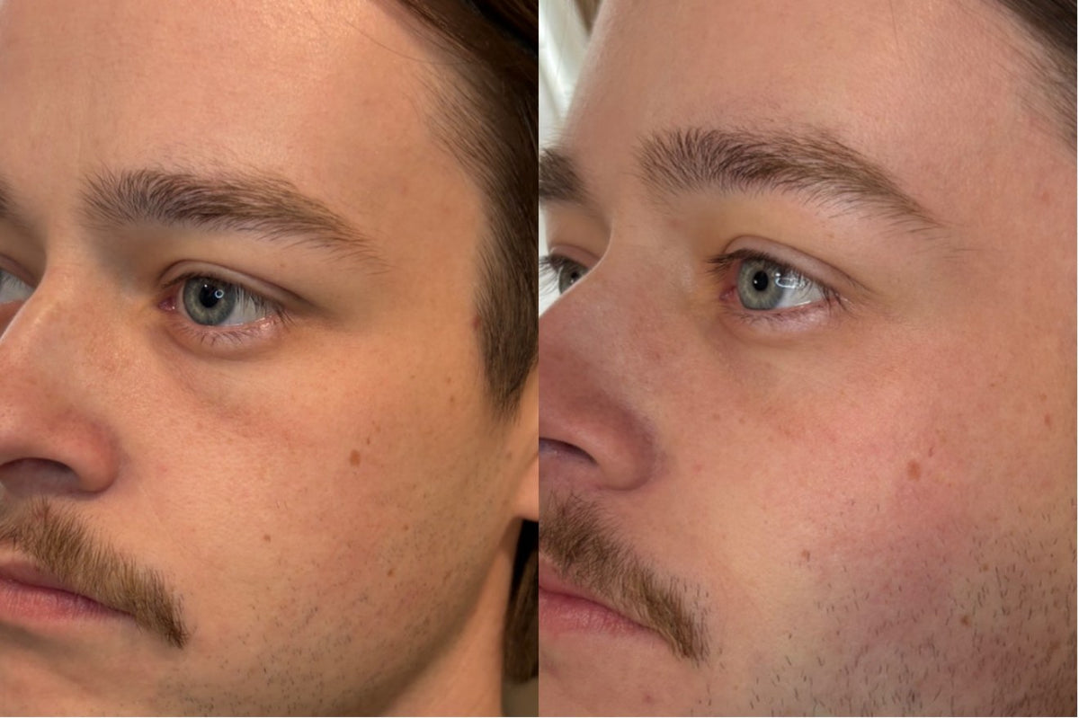 PRF before and after — under-eye area, male client