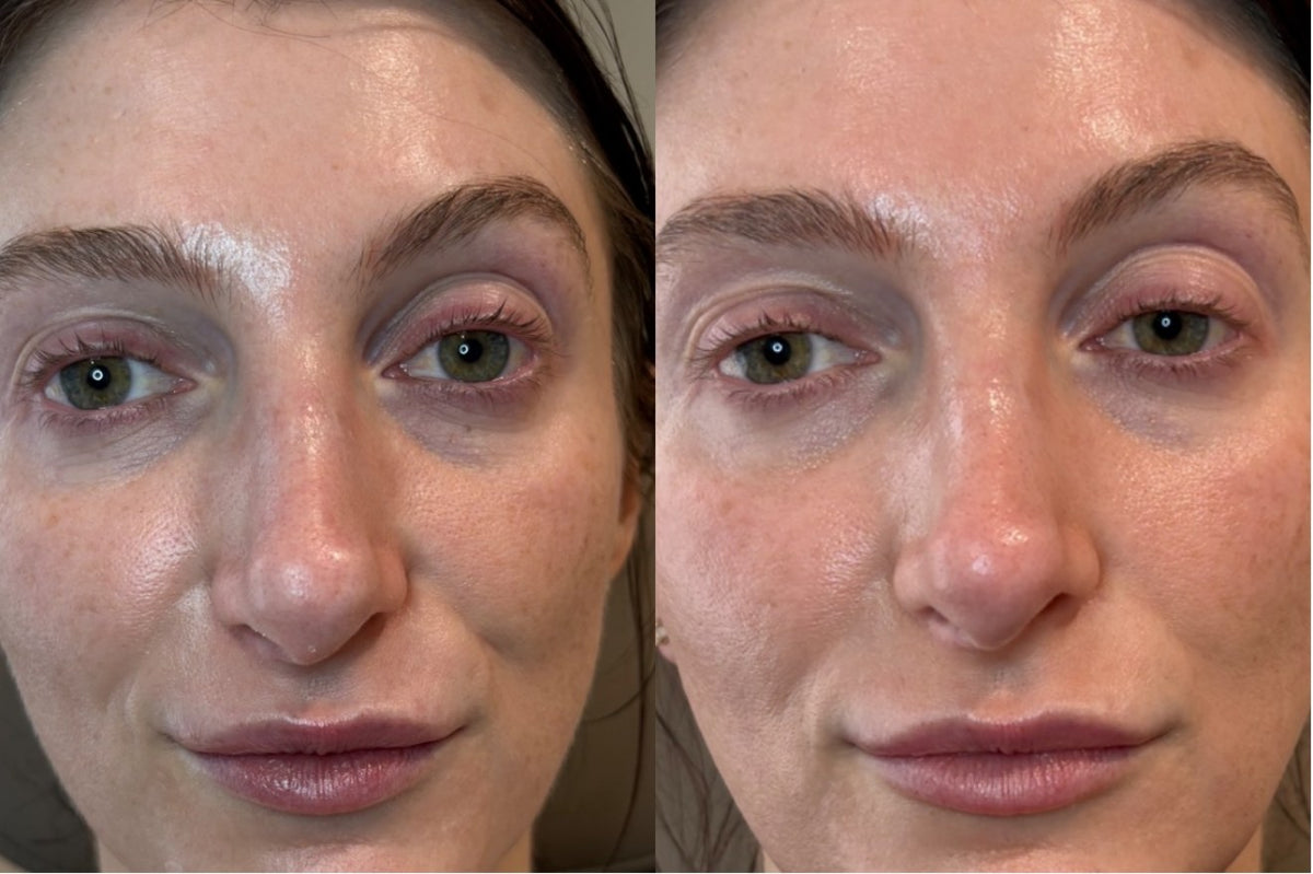 PRF before and after — under-eye brightness and texture