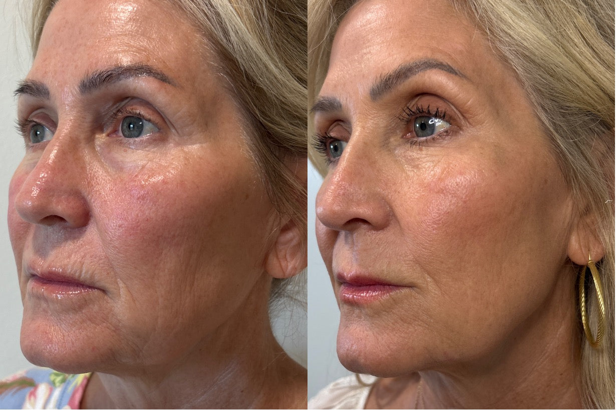 Sculptra before and after — skin quality and facial volume