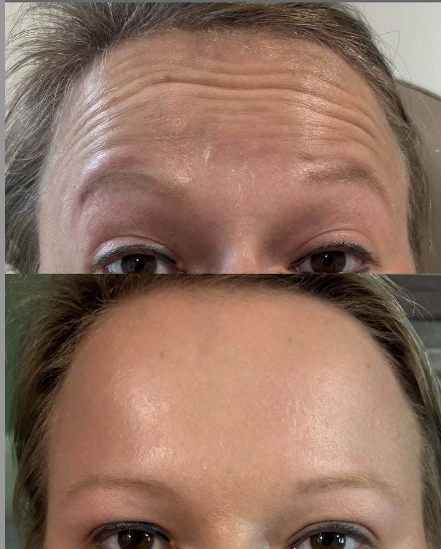Tox before and after — forehead lines