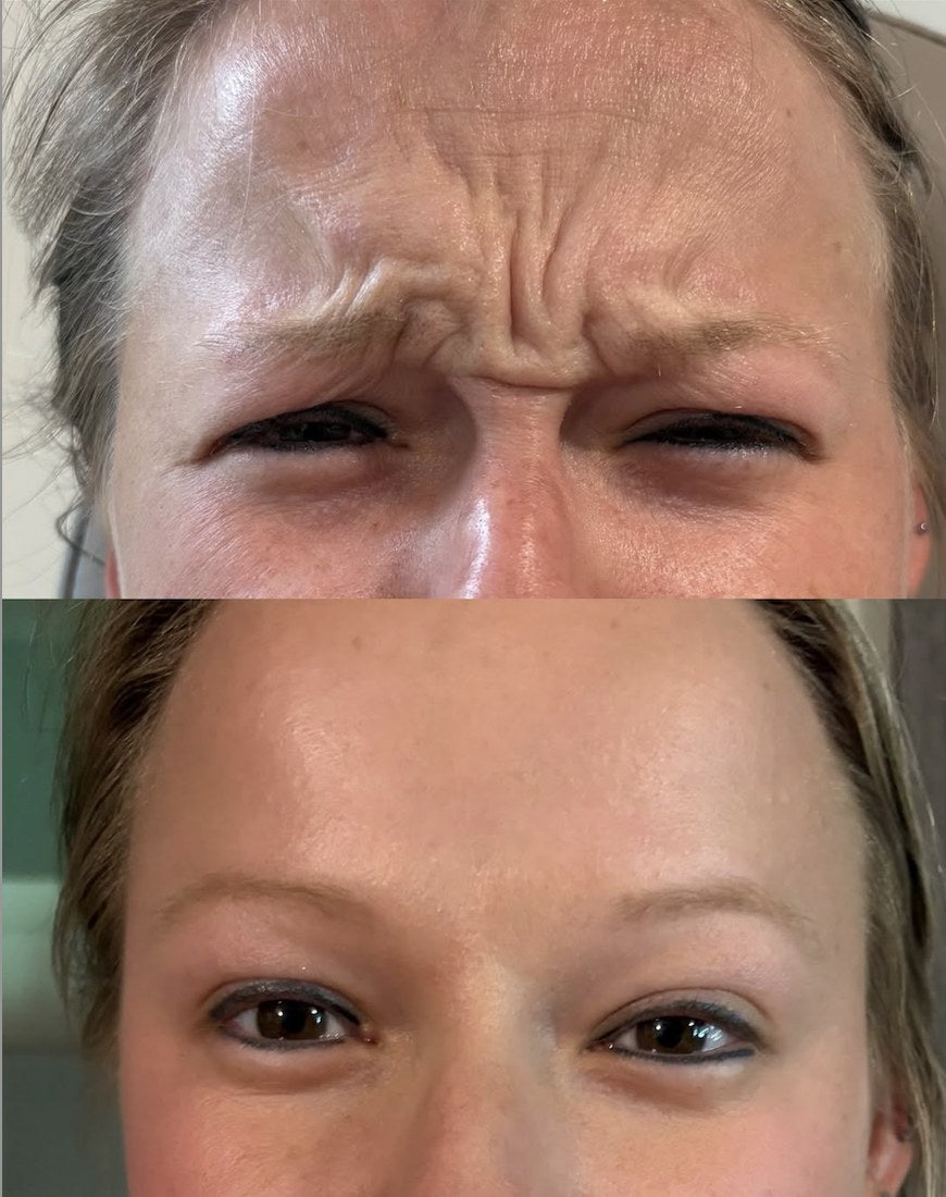 Tox before and after — frown lines between the brows